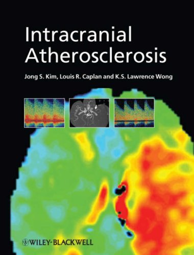 Intracranial Atherosclerosi